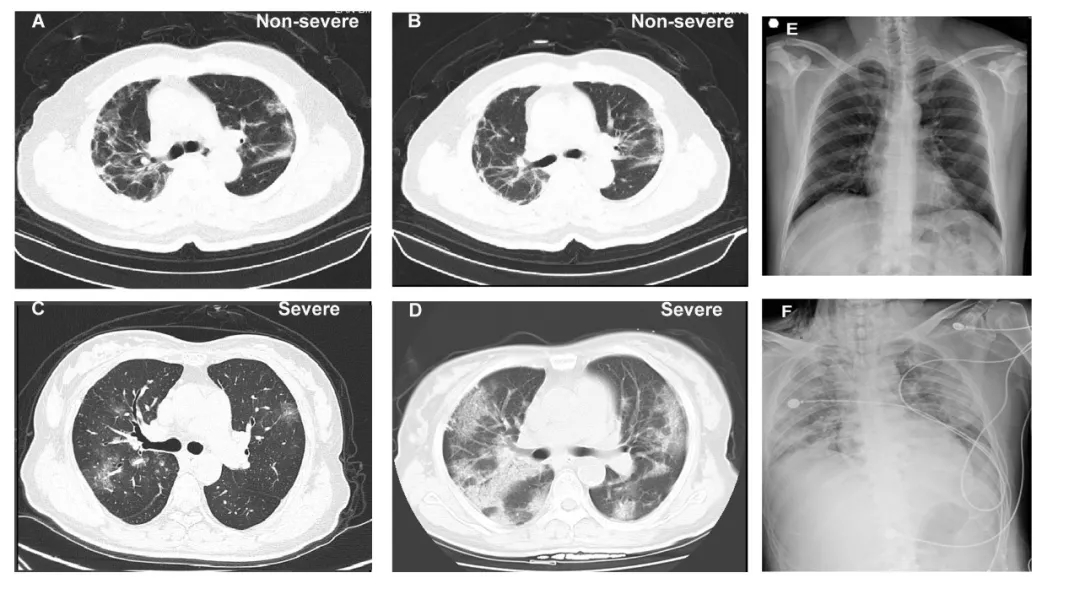 新冠肺炎患者影像学改变